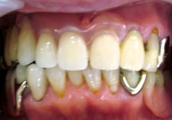 前歯のスマイルデンチャー